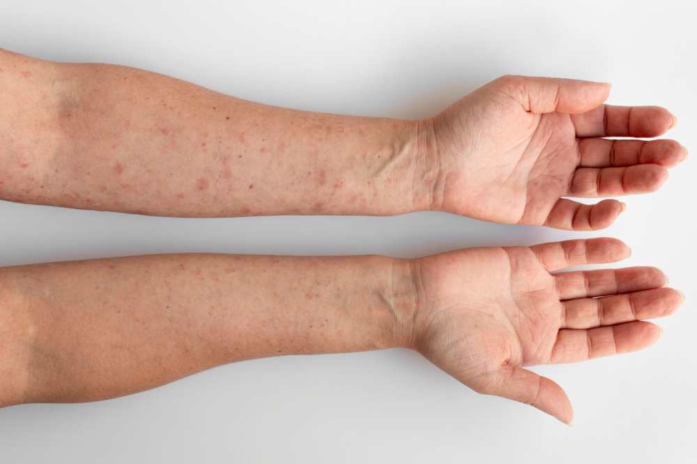 Lupénka (psoriasis) jak ji poznat, příznaky a účinná léčba 